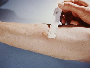 focolaio-di-tubercolosi-ad-alcamo-situazione-sotto-controllo-nessun-nuovo-caso-emerso