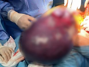 marsala-ospedale-borsellino-intervento-durgenza-asportato-un-fibroma-di-16-kg-dallutero-di-una-paziente-di-54-anni