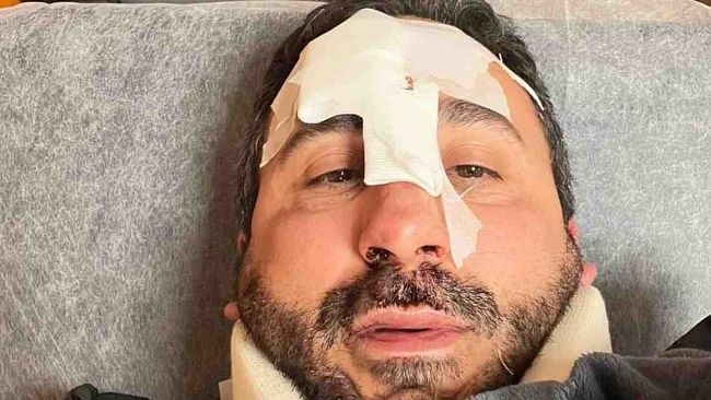 Incidente in monopattino per lo chef Natale Giunta