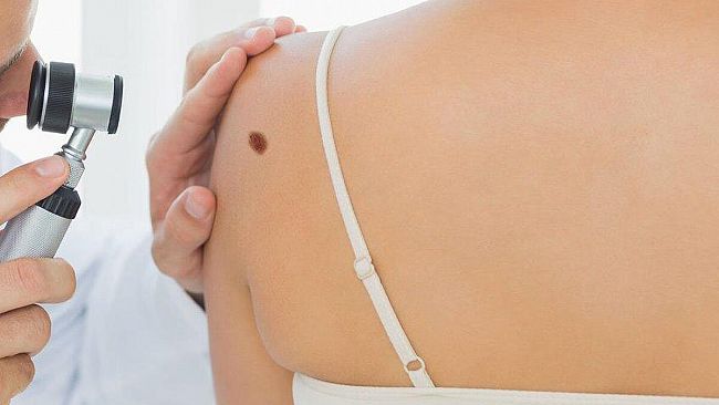 Trapani, incontro su Skin Cancer: il melanoma fa meno paura