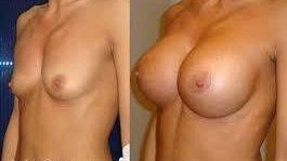 Rifarsi il seno? Ne parliamo con il dott. Gaspare Reina, specialista in Chirurgia Plastica e Ricostruttiva